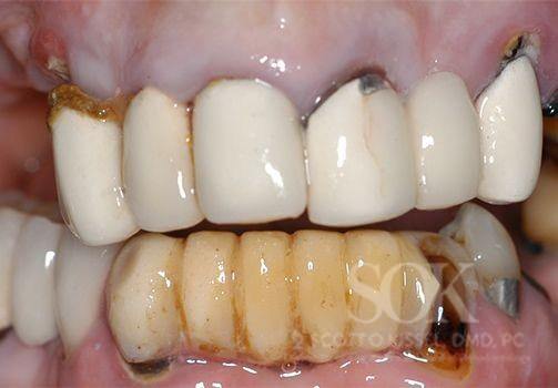 Patient 1 All-on-4® Dental Implants Before Image 1 Cropped Copy 1