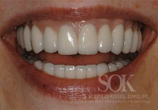 Patient 1 All-on-4® Dental Implants After Image 1 Bright Copy