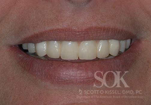 Patient 2 After All-on-4® Dental Implants Copy
