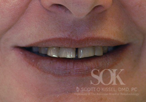 Patient 2 Before All-on-4® Dental Implants Copy