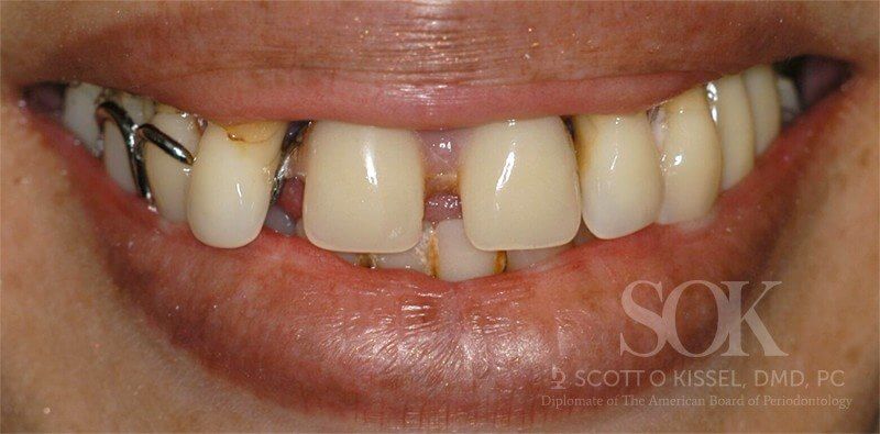 Patient 3 Before All-on-4® Dental Implants Copy
