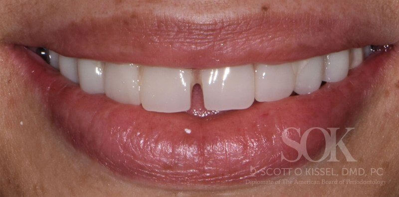Patient 3 After All-on-4® Dental Implants Copy