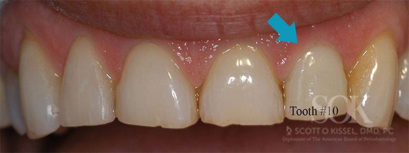 Case Study #1 Dental Implant 1 Week After With Blue Arrow Pointing to Tooth #10