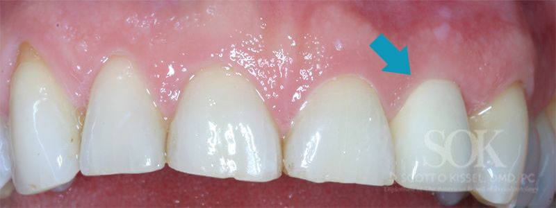 Case Study #1 Dental Implant Final Crown Copy 2