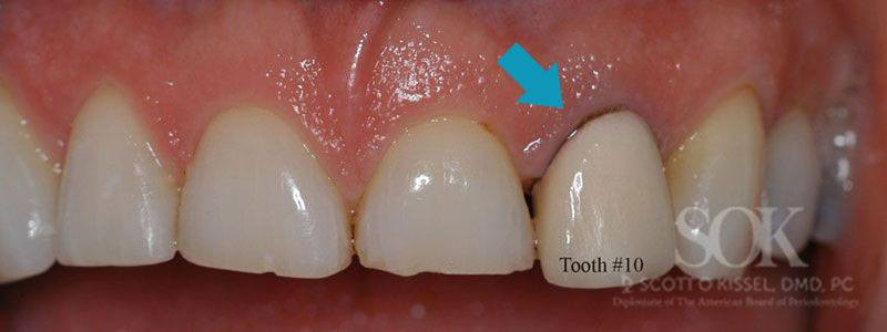 Case Study #1 Before Dental Implant Copy 4
