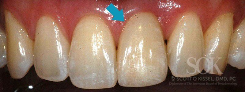 Case Study #2 After Dental Implant With Blue Arrow Pointing To Left Front Tooth