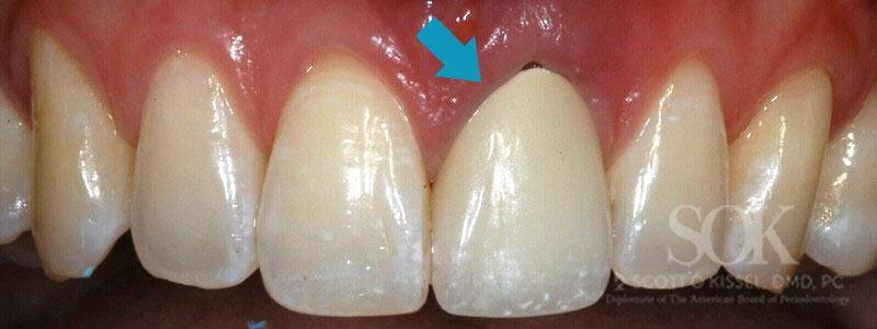 Case Study #2 Before Dental Implant With Blue Arrow Pointing To Right Front Tooth