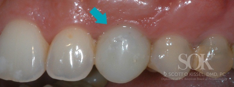 Case Study #3 After Dental Implant With Blue Arrow Copy