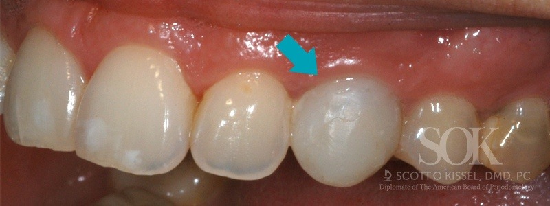 Case Study #3 Before Dental Implant With Blue Arrow Copy