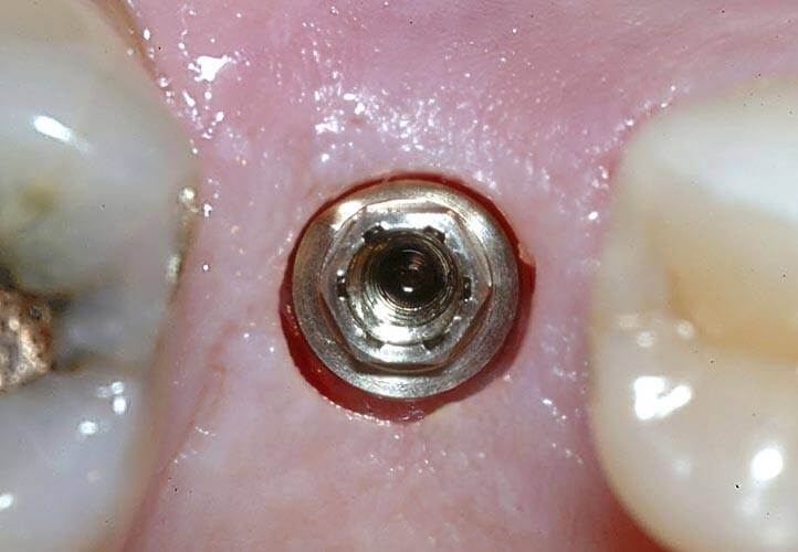 Dental Implant fixture and abutment photo