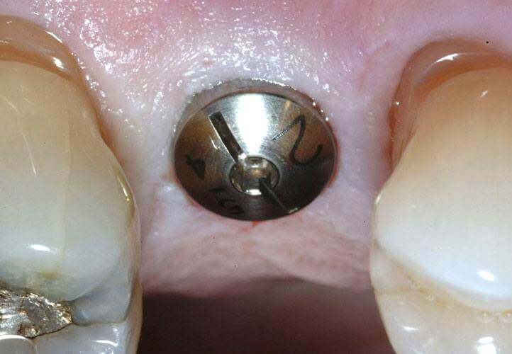 Dental implants abutement photo