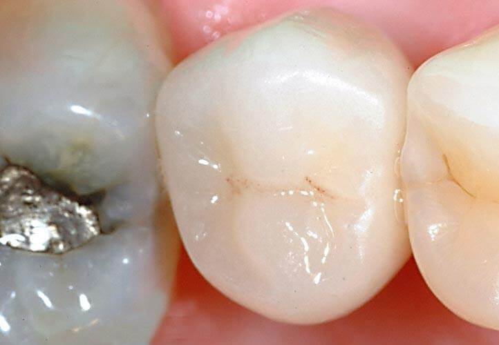 Dental implant with final crown photo