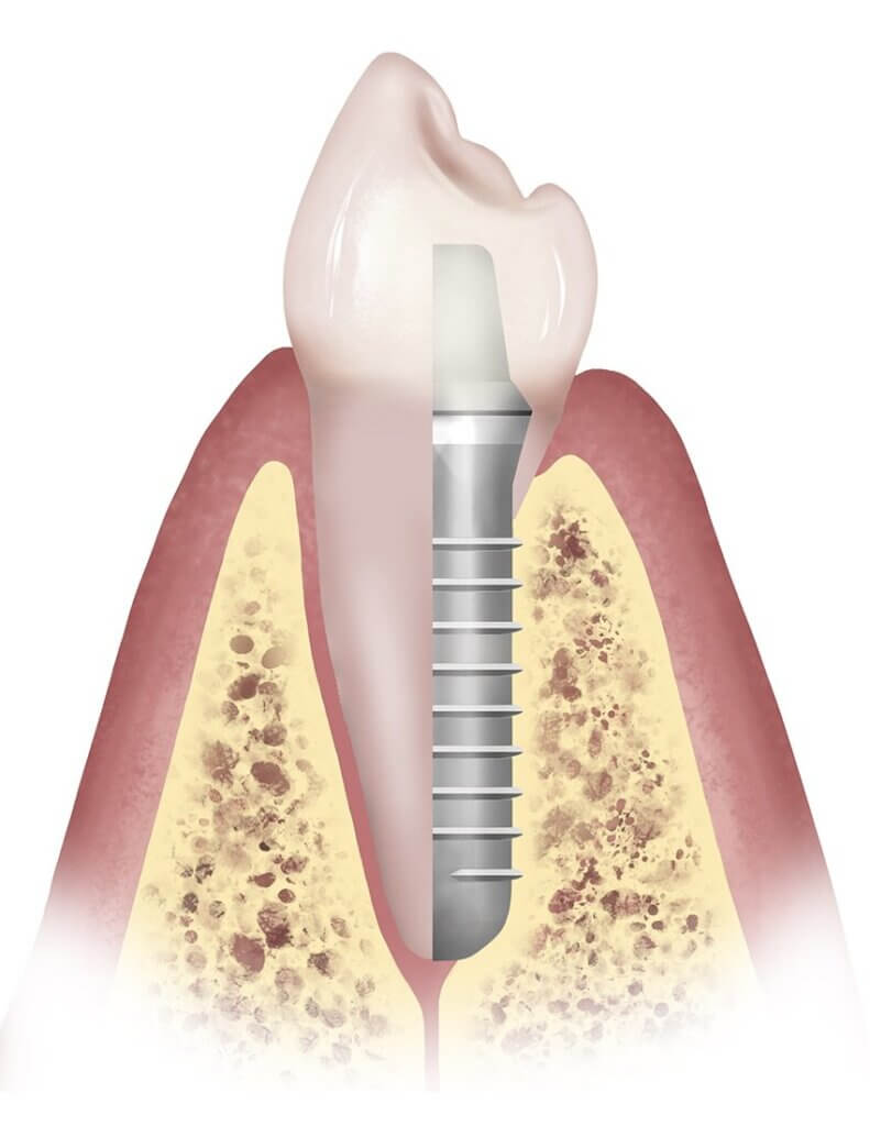 Diagram Showing Tooth and Dental Implant Comparison