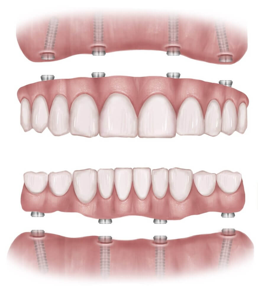 All-on-4 Dental Implants Gum and Teeth Diagram