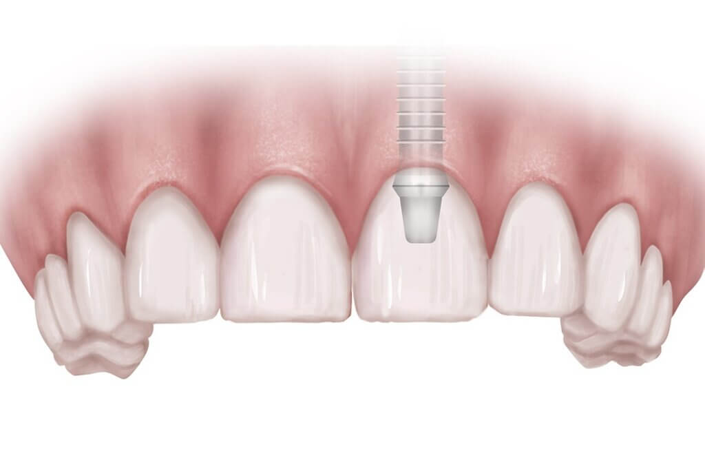 Drawing of Gum and Teeth Row Showing Overlaid Location of Dental Implant