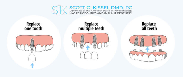 A diagram with the different types of dental implants to replace one tooth, multiple teeth and all teeth