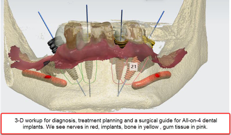 3-D workup for assisting in the dental implant procedure for All on 4