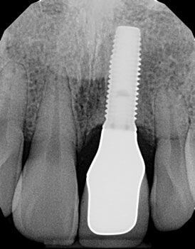 Case Study #2 Dental Implant X-ray Image 3 of dental implant fuse to bone