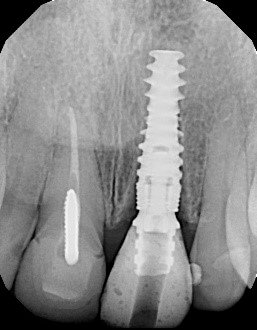 implant position relative to bone crest
