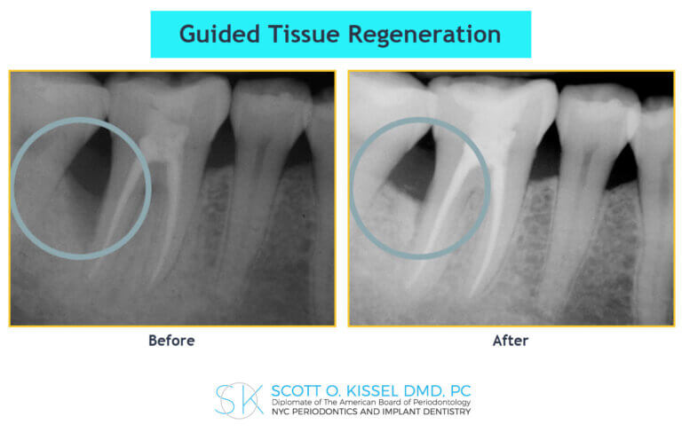 Before and after x-rays of guided tissue regeneration (GTR) performed by Dr. Kissel