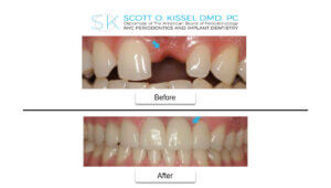 Before / after photos of a single tooth dental implant - front teeth
