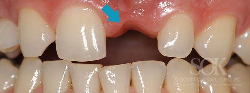 Patient 4 Before Dental Implants Close Up With Blue Arrow Pointing to Missing Tooth