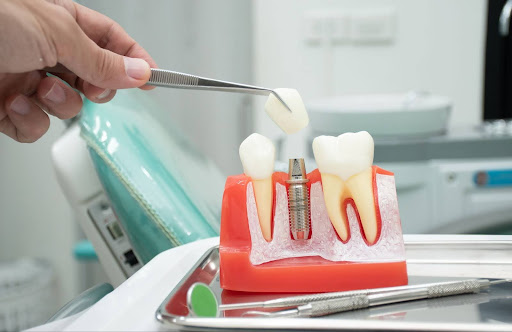 Model of dental implant procedure with hand holding tool, showcasing tooth replacement options relevant to tooth extraction and oral health care.