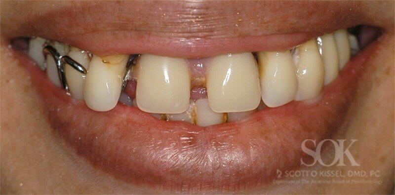 Patient 3 Before All-on-4® Dental Implants