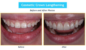 Before and after photos of crown lengthening using microsurgery by Dr Kissel