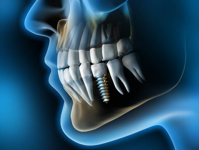 Dental Implant procedures to replace missing teeth