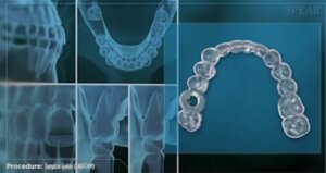 Dental Implant - Surgical Guide Retainer
