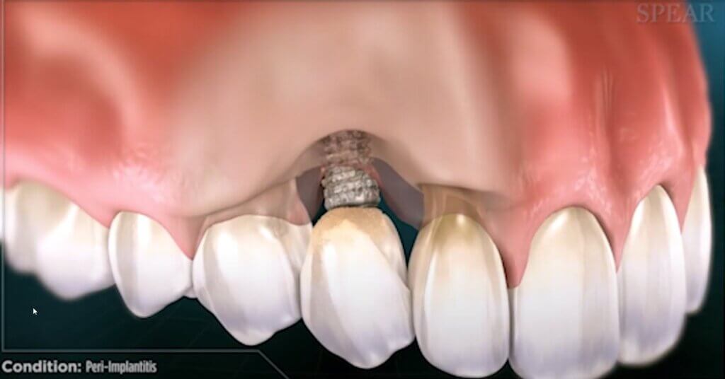 Dental Implant Issues - Peri-Implantitis