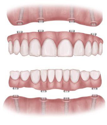 All on 4 Dental Implants Gum and Teeth Diagram
