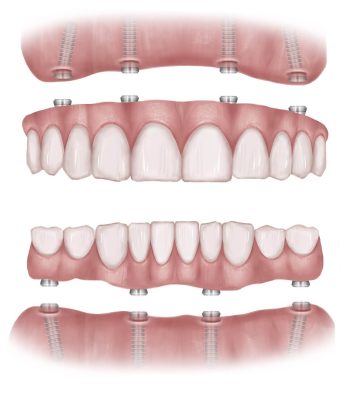 All on 4 Dental Implants Gum and Teeth Diagram