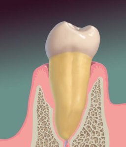 Graphic of Tooth and Gums After Perioscopy