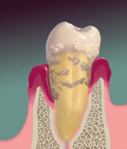 Graphic of Tooth and Gums Before Perioscopy