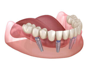 All-on-4 dental implants low arch showing 4 implants