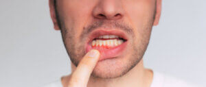 Young man pointing at his inflamed gums, suggesting the onset of gum disease, leading to gingivitis