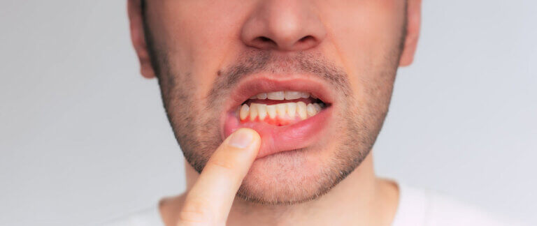 Young man pointing at his inflamed gums, suggesting the onset of gum disease, leading to gingivitis