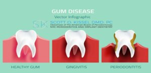 a graphic image showing the stages of gum disease