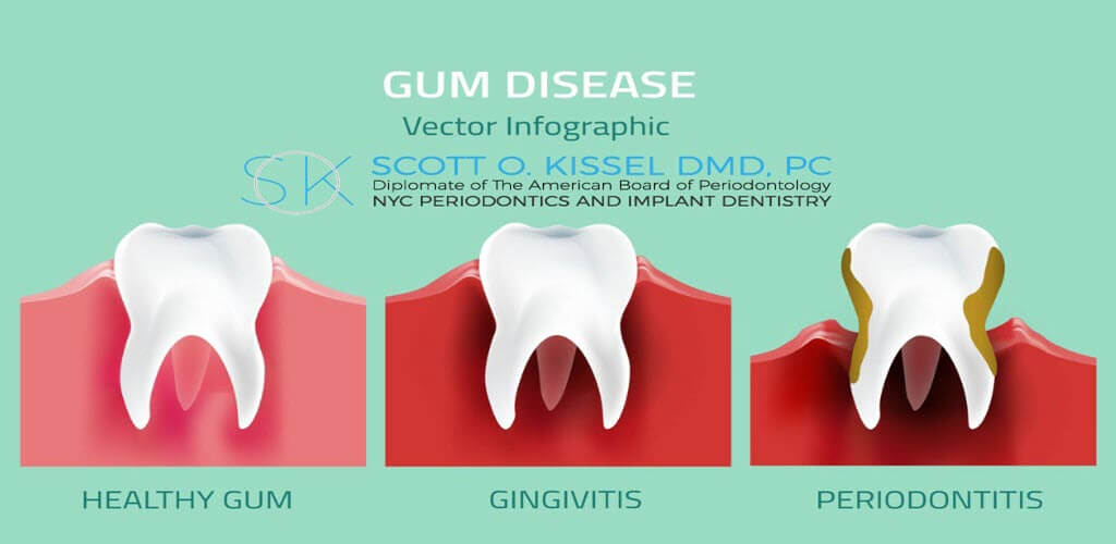 a graphic image showing the stages of gum disease