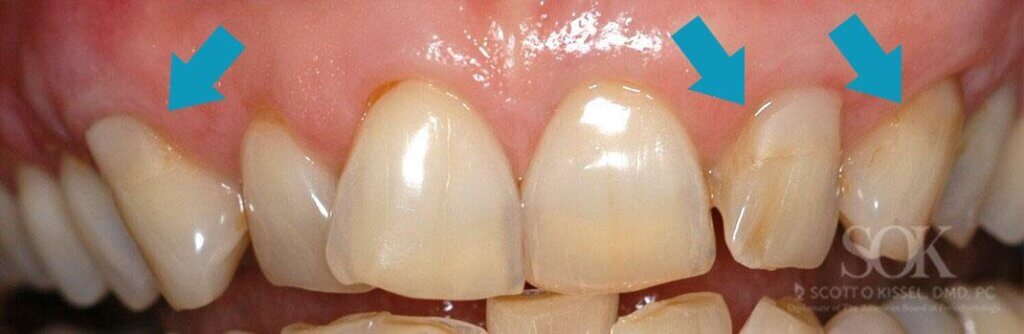 Patient 1 After Gum Tissue Graft With 3 Blue Arrows Pointing To Treatment Areas