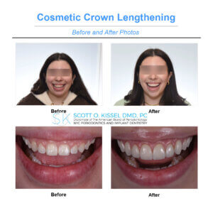 Cosmetic Crown Lengthening before and after photos of a young woman