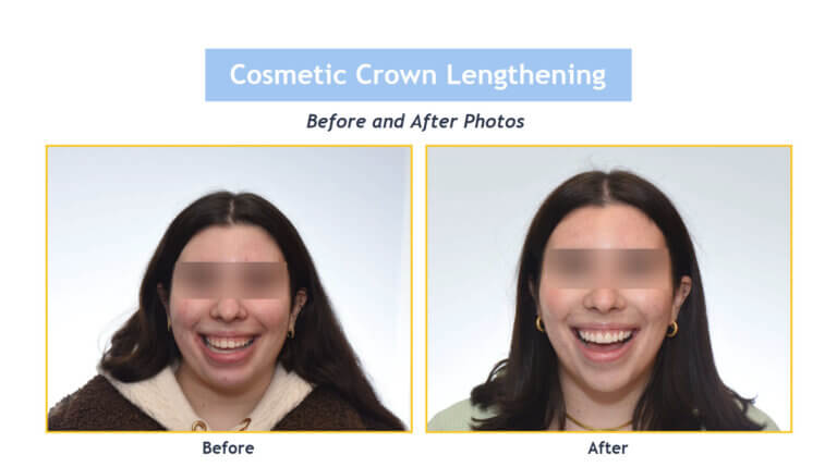 Cosmetic Crown Lengthening before and after photos of a young woman