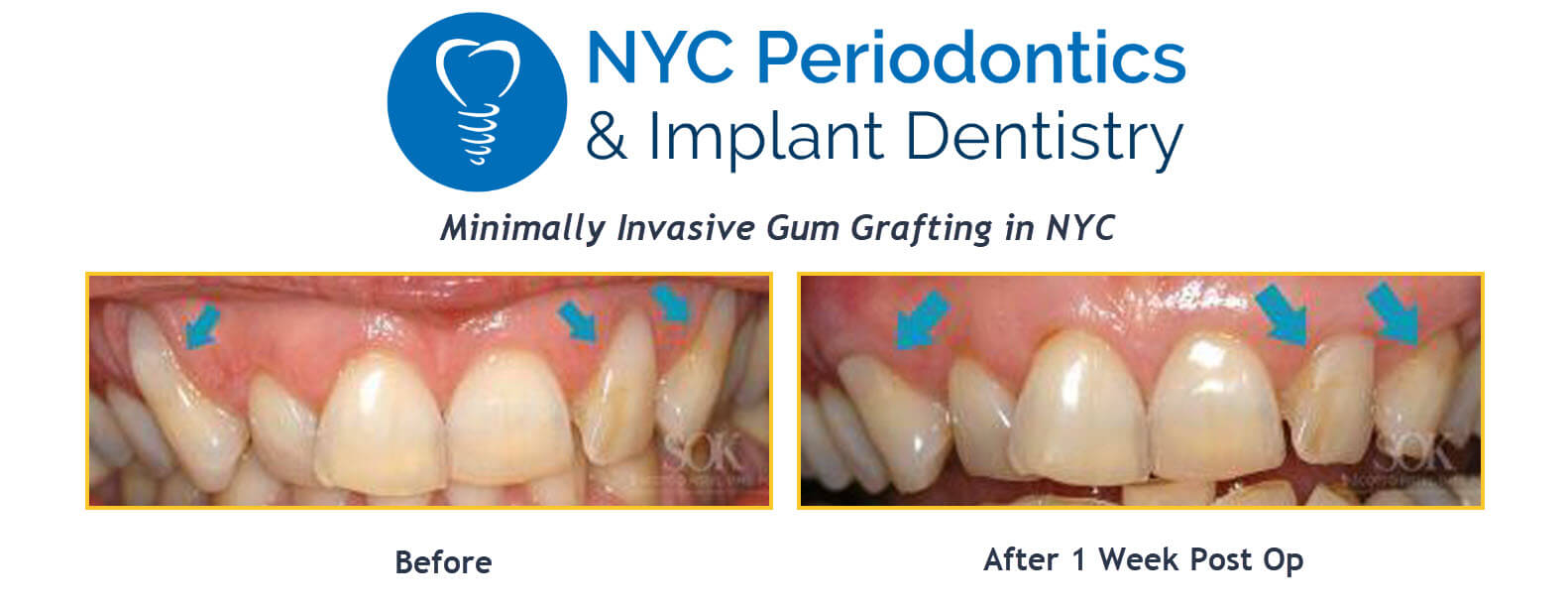 Before and after photos of gum grafting in NYC using microsurgery