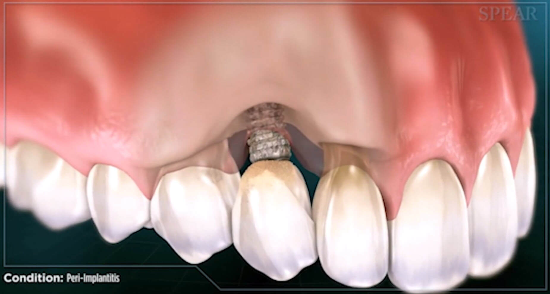An image of a tooth implant exposed due to peri-implantitis