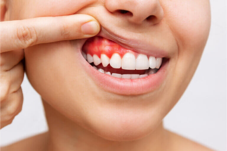 a young woman showing her red and swollen gums suggesting the onset of gum disease