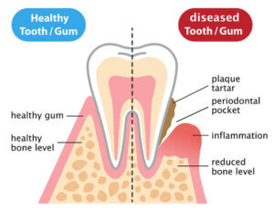human teeth of gum disease / periodontitis and normal teeth illustration isolated on white background