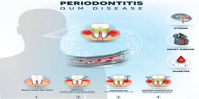 Periodontitis or periodontal disease chart of symptoms and causes of gum disease