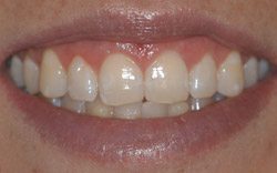 After Crown Lengthening by Dr. Kissel